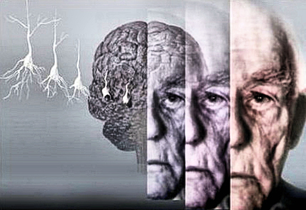 Обнаружены гены которые отвечают за болезнь Альцгеймера