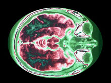 Ученые предлагают лечить тревогу электростимуляцией мозга