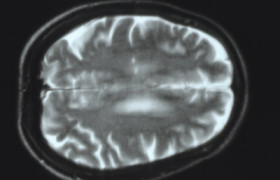 Трансплантация стволовых клеток способна защитить от рассеянного склероза