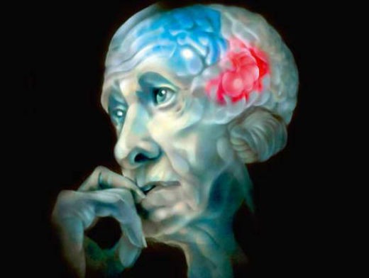 Дегенерация белого вещества в мозге может оказаться ранним маркером определенных типов болезни Альцгеймера