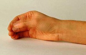 Одной из причин развития болезни Паркинсона является сырость