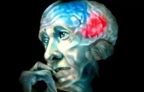 Ученые научились опеределять болезнь Альцгеймера за 10 лет до первых симптомов