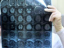 Гены болезни Альцгеймера увеличивают вероятность кровоизлияния в мозг