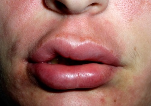 Опухла губа после анестезии: в чем причина и как лечить?