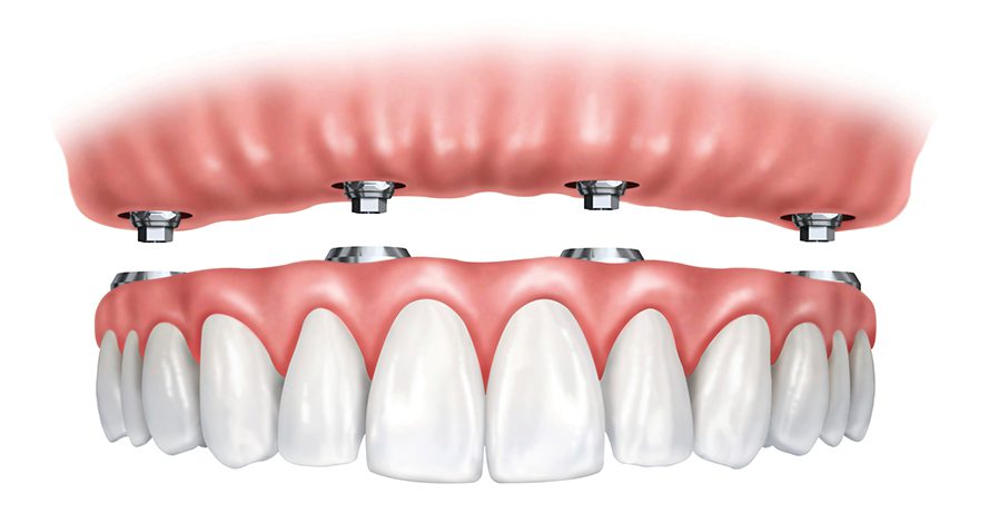 Несъемное протезирование на имплантатах при полном отсутствии зубов