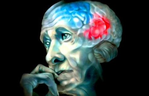 Экспериментальный препарат замедлил развитие болезни Альцгеймера в ходе клинического исследования