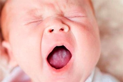 «Молочница» у младенцев — особенность кандидоза слизистой рта