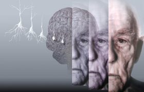 Исследователям удалось узнать больше о болезни Альцгеймера
