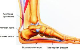 Народные способы лечения пяточных шпор, мозолей и потливости ног