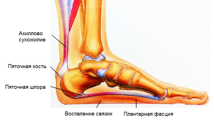 Народные способы лечения пяточных шпор, мозолей и потливости ног