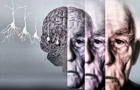 Опасности старости – сосудистая деменция