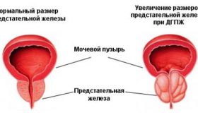 Острый простатит