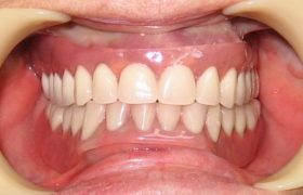 Типы съемных зубных протезов