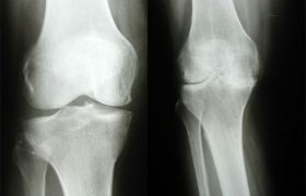 Причины, клиника, лечение артроза