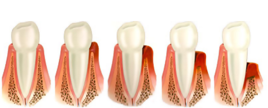 Зубная проблема – пародонтоз, причины возникновения, методы лечения