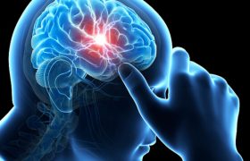 Транзиторная ишемическая атака