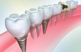 Стоматология ортопедическая – восстановление зубов