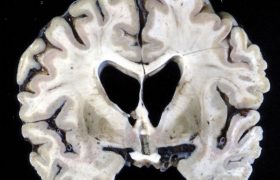 Задняя корковая атрофия