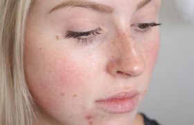 Что необходимо делать, если мучают прыщи