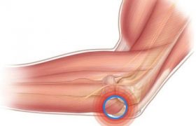 Бурсит локтевого и коленного сустава