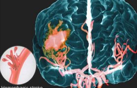 Геморрагический инсульт