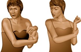 Болезнь Хантингтона