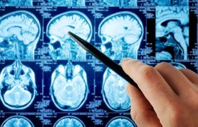Что нужно знать о раке мозга