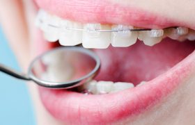 Брекеты — наиболее эффективный метод исправления зубных дефектов