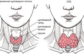 Эутиреоидный зоб