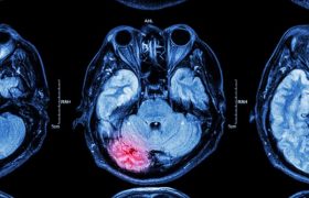 Учёные рассказали, как восстановить мозг после травмы