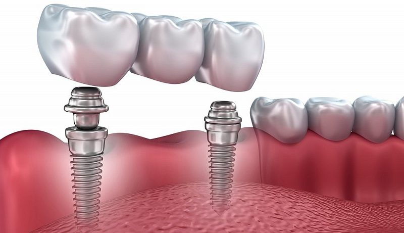 Имплантация зубов: всё, что необходимо знать