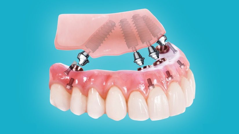 Протезирование all-on-4: современный подход к проблеме потери зубов