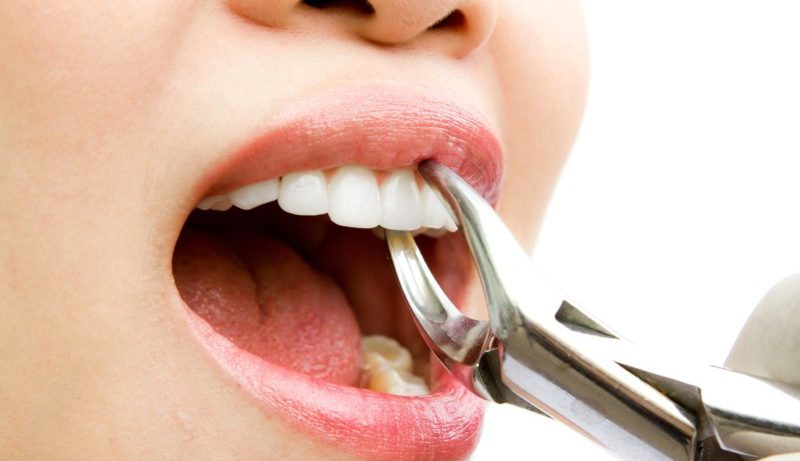 Протезирование зубов. Простые косметические стоматологические процедуры