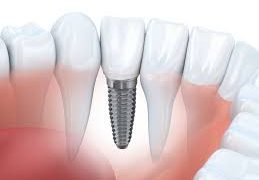 Стоматология. Изучение имплантации зубов