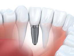 Стоматология. Изучение имплантации зубов