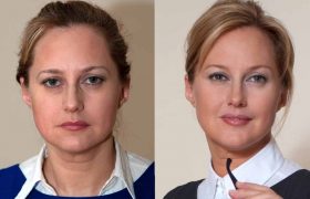 Биореструктуризация кожи с гидроксиапатитом кальция