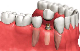 Об имплантации зубов
