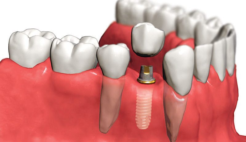 Об имплантации зубов