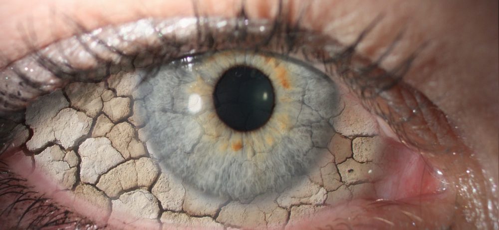 Как избавиться от синдрома сухого глаза?