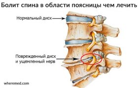Болит спина в области поясницы? Узнай чем лечить