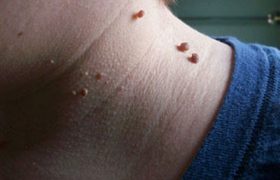 Папилломы — это нарастания на коже или слизистых оболочках
