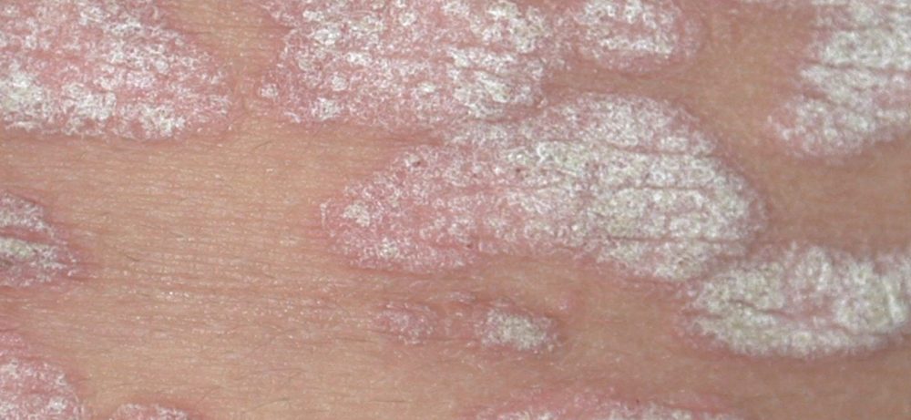 Псориаз и другие кожные заболевания у малышей