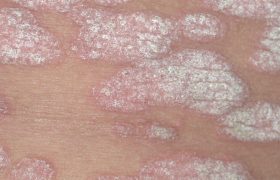 Псориаз и другие кожные заболевания у малышей