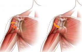 Растяжение плеча