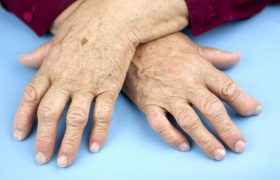 Ревматоидный артрит: симптомы, диагностика и лечение