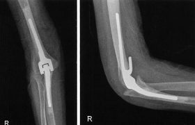 Для чего необходимо приобретать протез?