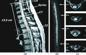 Сирингомиелия