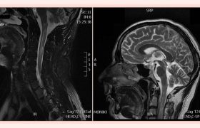 Оптикомиелит