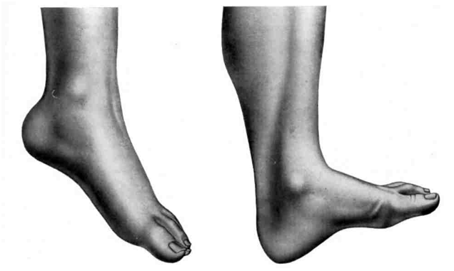Паралич ног
