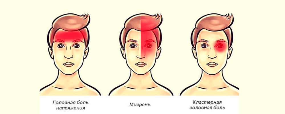 Кластерная головная боль